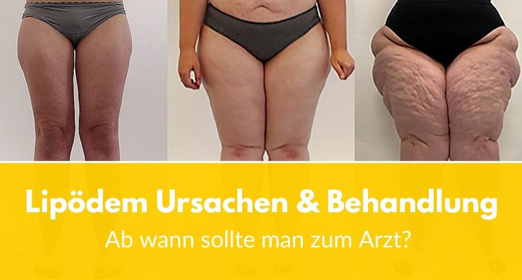 Lipödem Ursachen & Behandlung: Ab wann sollte man zum Arzt?