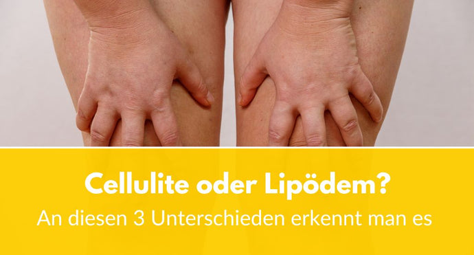 Cellulite oder Lipödem: Erkennbar an diesen 3 Unterschieden!