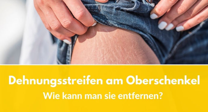Dehnungsstreifen am Oberschenkel: Wie kann man sie entfernen?
