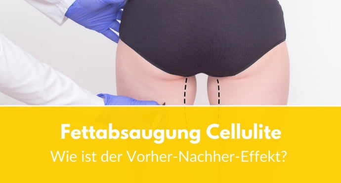 Fettabsaugung Cellulite: Wie ist der Vorher-Nachher-Effekt?