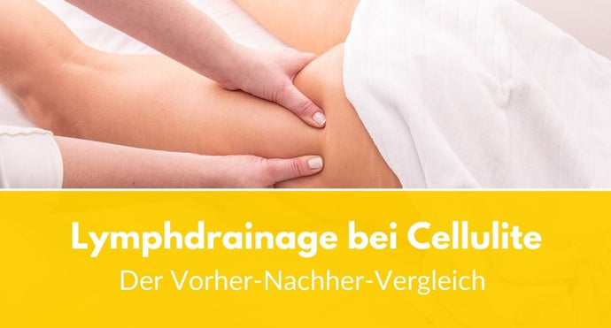 Lymphdrainage bei Cellulite: Der Vorher-Nachher-Vergleich!