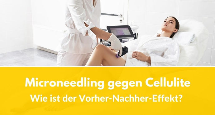 Microneedling gegen Cellulite: Wie ist der Vorher-Nachher-Effekt?
